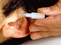 Implantat-Akupunktur bei Raucherentw�hnung
